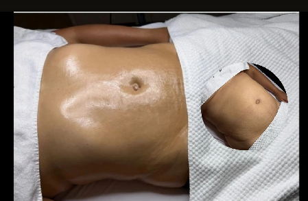 waist +Abdominal  $99.99 》 Book Here • Brazilian lymph drainage  thumbnail