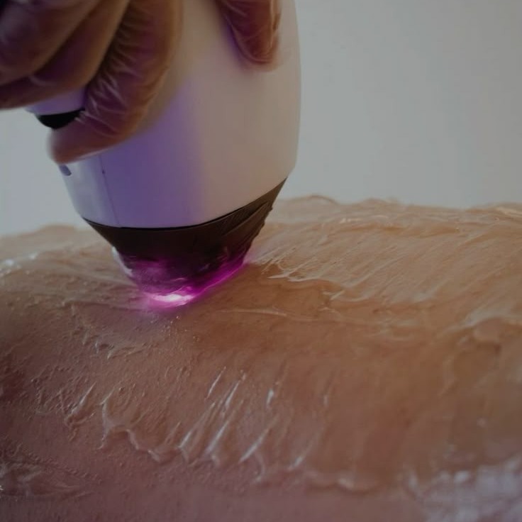 Depilação a laser thumbnail