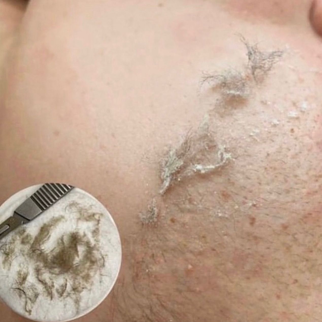 Dermaplaning thumbnail