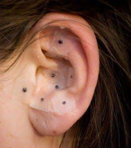Auriculoterapia thumbnail