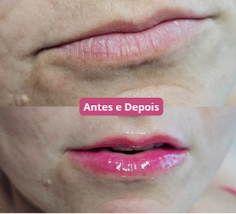 Antes e Depois thumbnail