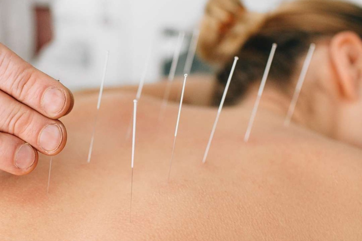 Acupuntura thumbnail
