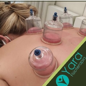 Ventosaterapia thumbnail