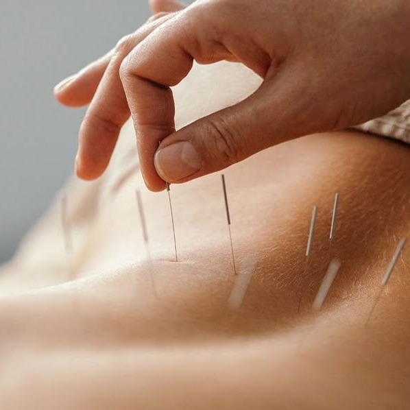 Acupuntura thumbnail