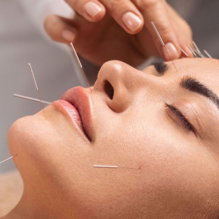 Acupuntura Estética Facial thumbnail