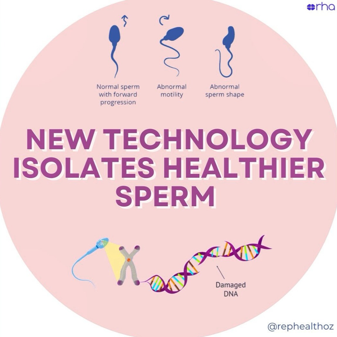 A biomimetic sperm selection device for routine sperm selection thumbnail