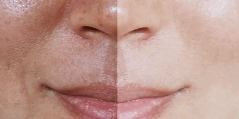 Laser Lavieen thumbnail