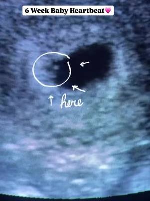 ✨ Life Starts Small ✨ At just 6 weeks, a baby’s heart is already forming and flickering 💓—about the size of a poppy seed