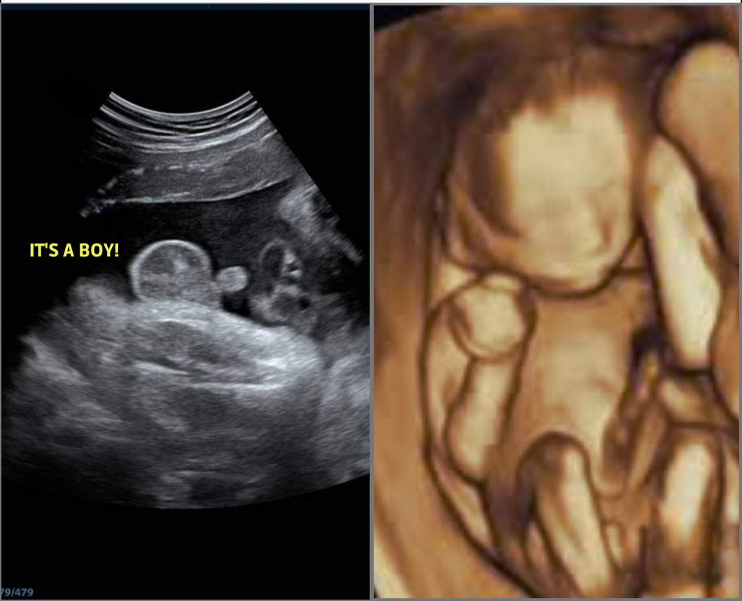 Gender Reveal + 3D/4D Peek Special-14 Weeks+ thumbnail