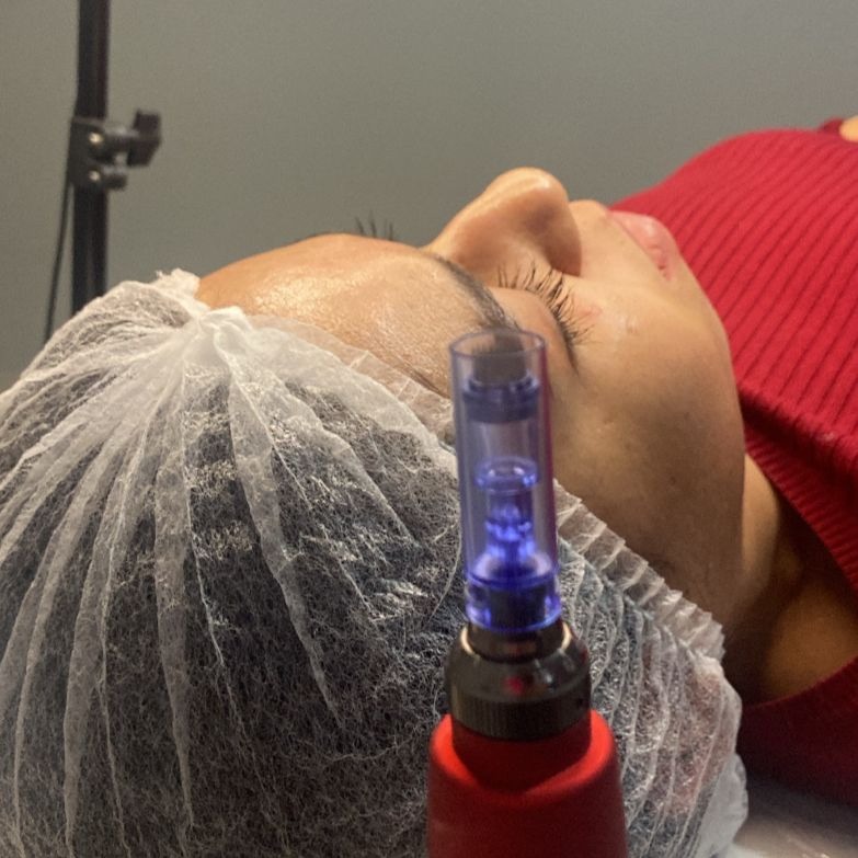 Microagulhamento facial thumbnail