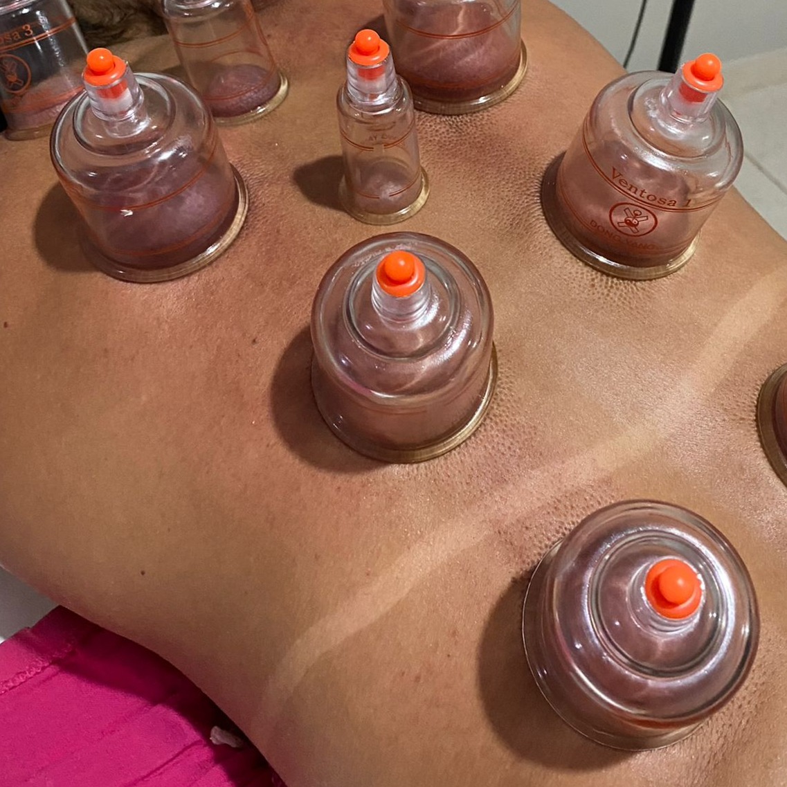 Ventosaterapia thumbnail