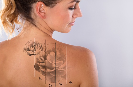 Remoção de Tatuagem thumbnail