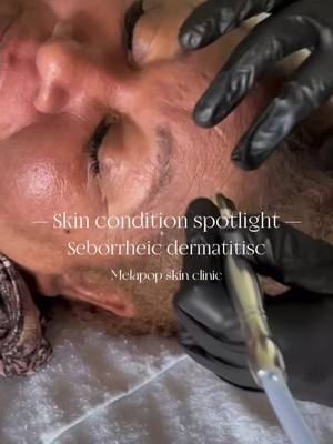 Many people are still unaware that you can experience Seborrheic dermatitis on face just as you can on the scalp. While 