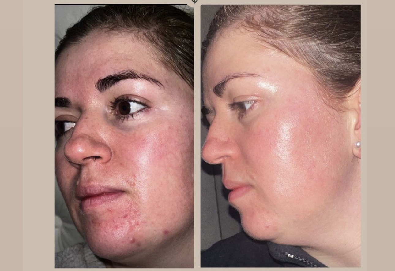 ESCANER FACIAL PARA CONOCER LAS NECESIDADES DE TU PIEL thumbnail