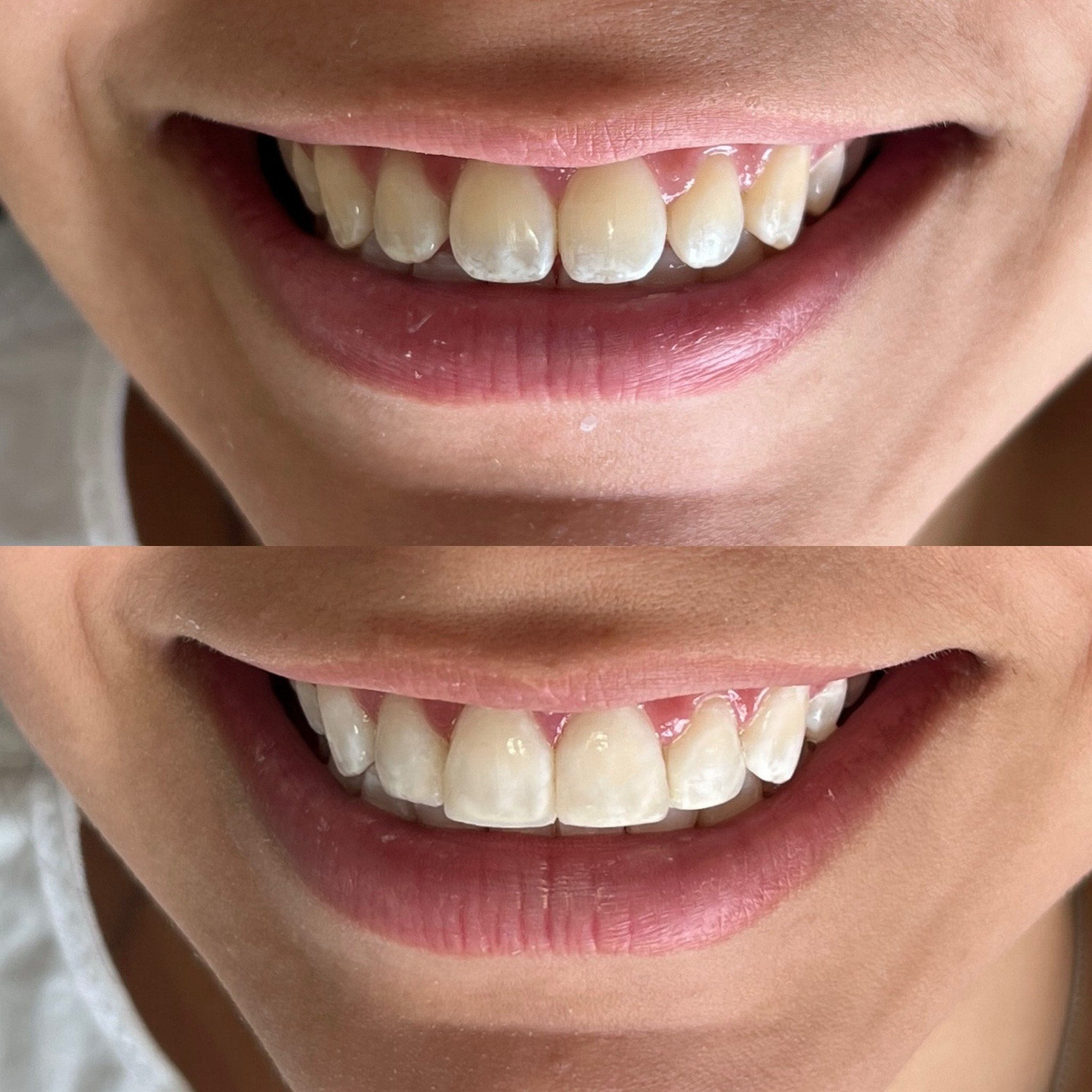 Clareamento de consultório + acréscimos em resina 🥰