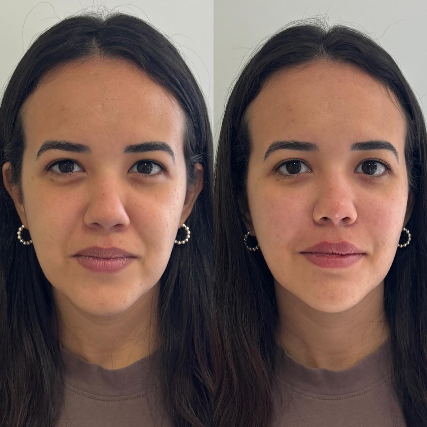 ✨ Caso de rejuvenescimento facial iniciado!
Andreza me procurou se queixando do derretimento da face, que ressaltava sua