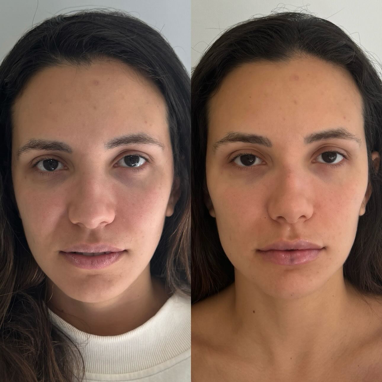 ✨ Harmonização facial é isso: mudou algo, melhorou, mas… o que?! Ela já era linda e ficou ainda mais!
Realçando a beleza