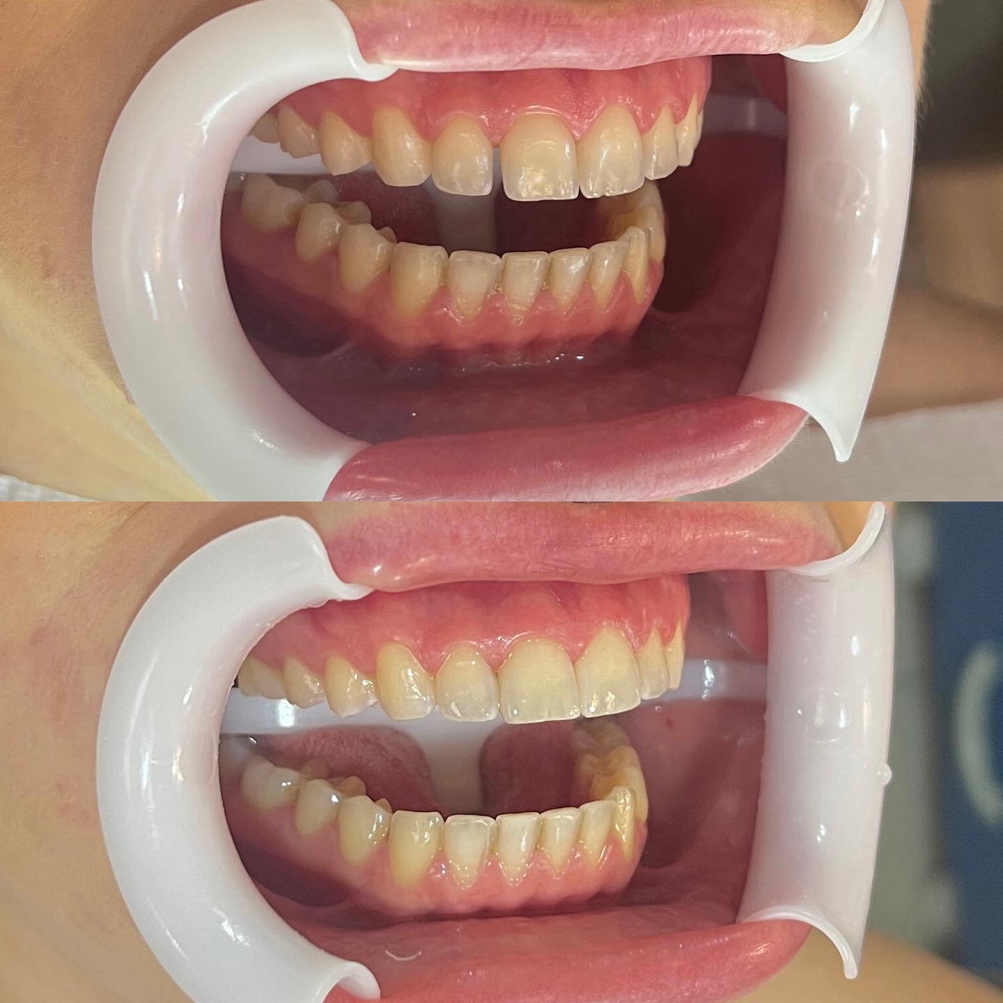 Um pouco mais da odontologia conservadora que eu trabalho aqui pra vocês 🦷
No caso da Andressa, eu realizei alguns acrés