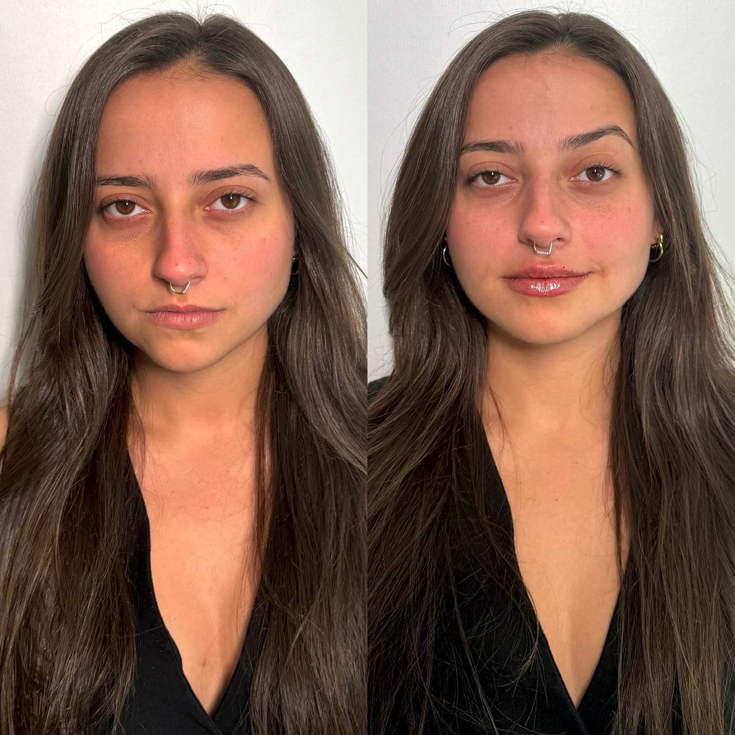 ✨ Caso de preenchimento labial e rinomodelação dessa paciente linda! Ela não queria nada que mudassem seus traços e assi