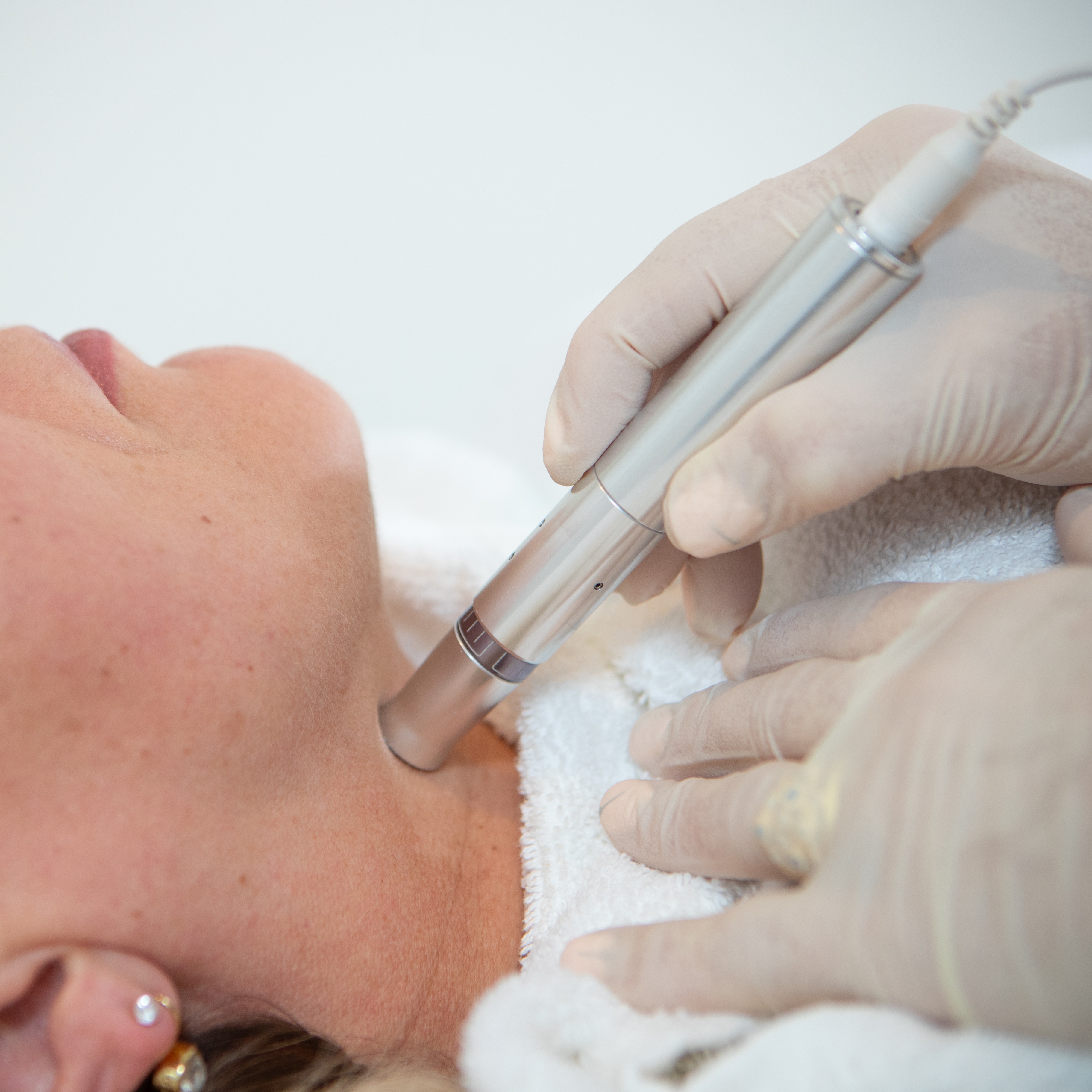 RF Dermal Needling thumbnail