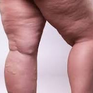 Lipedema thumbnail