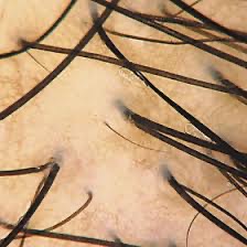 Scalp Analysis thumbnail