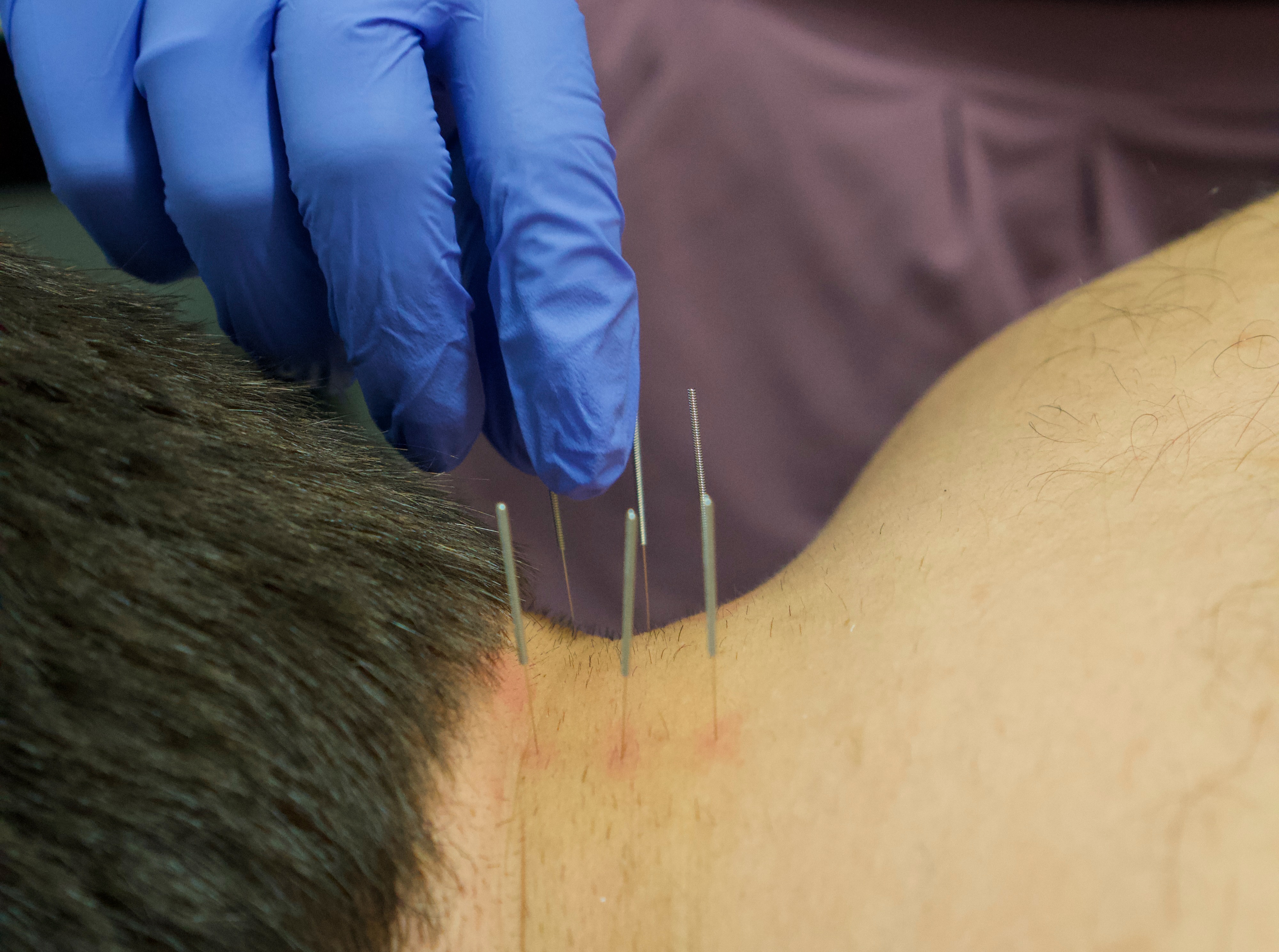 BOOK DRY NEEDLING thumbnail
