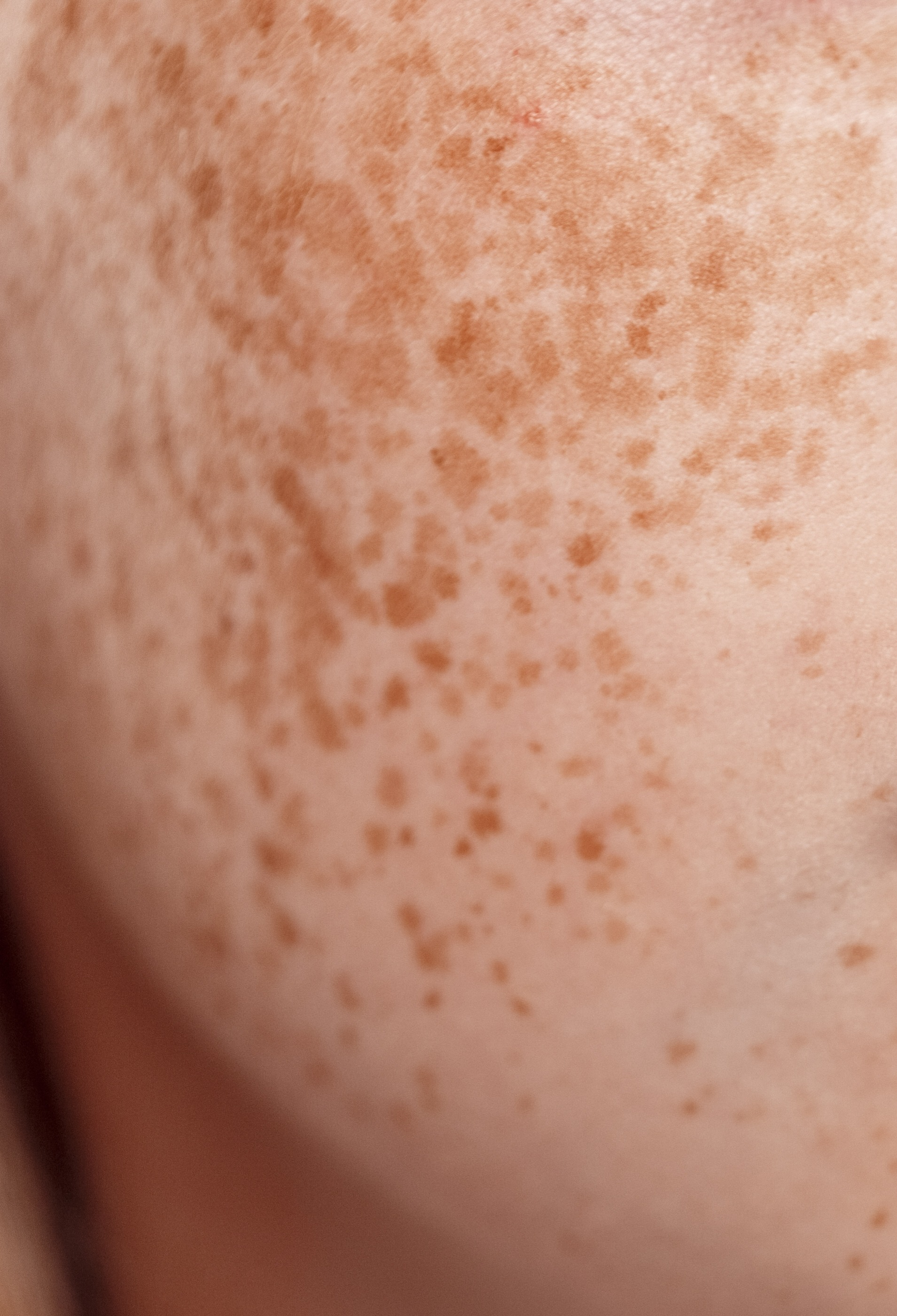 Efélides ou sardas thumbnail