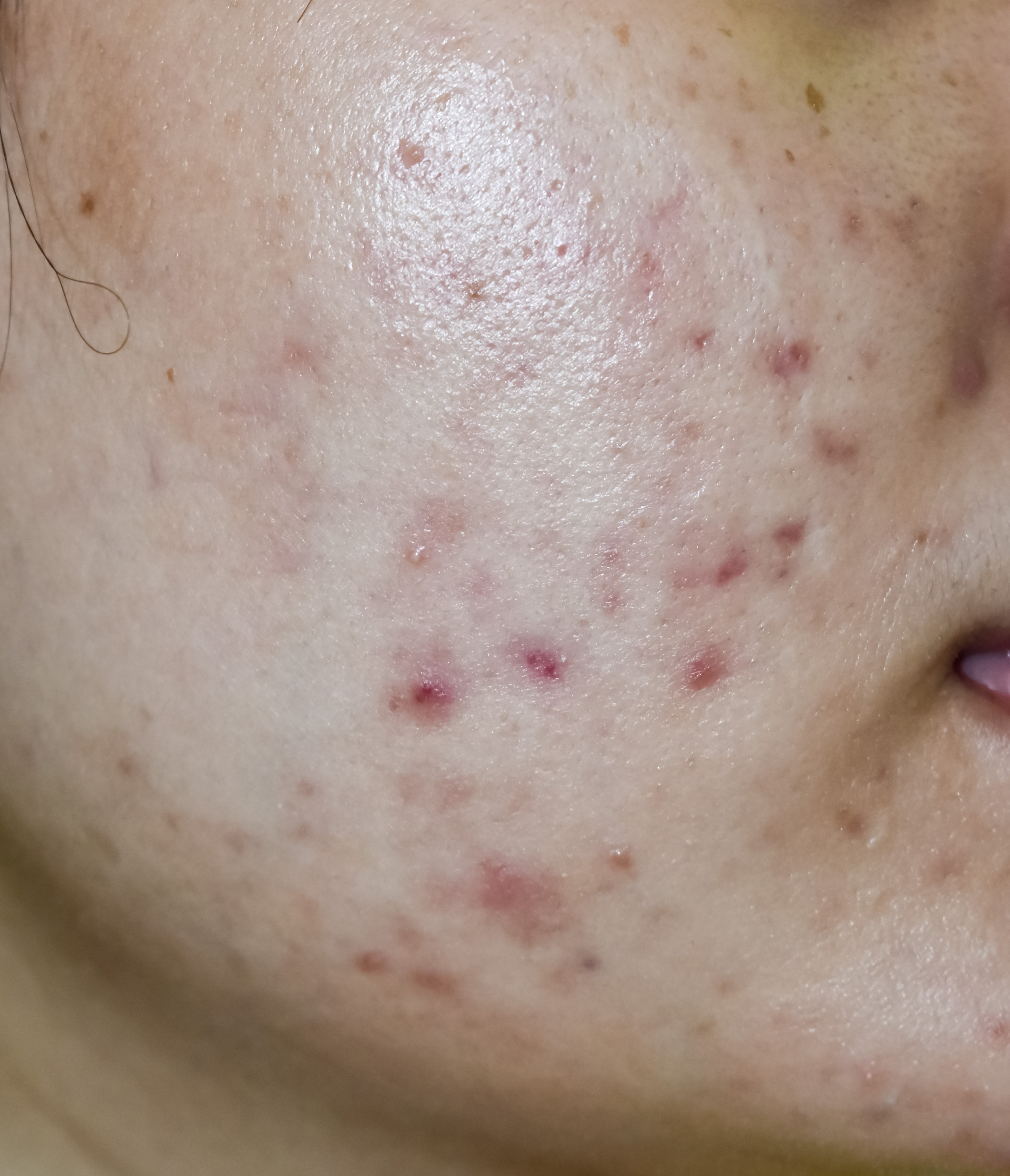 Manchas de acne pós inflamatório thumbnail