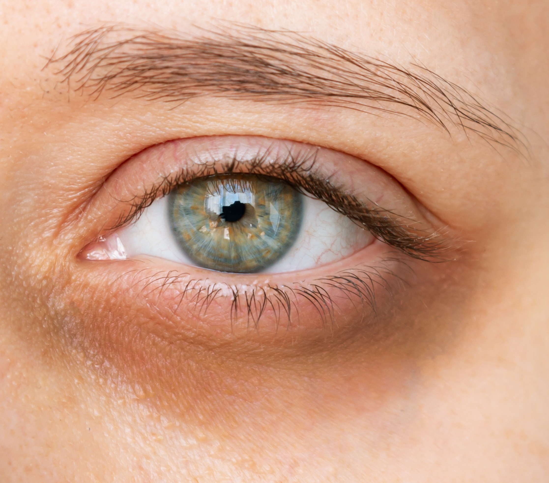 Olheiras pigmentadas thumbnail