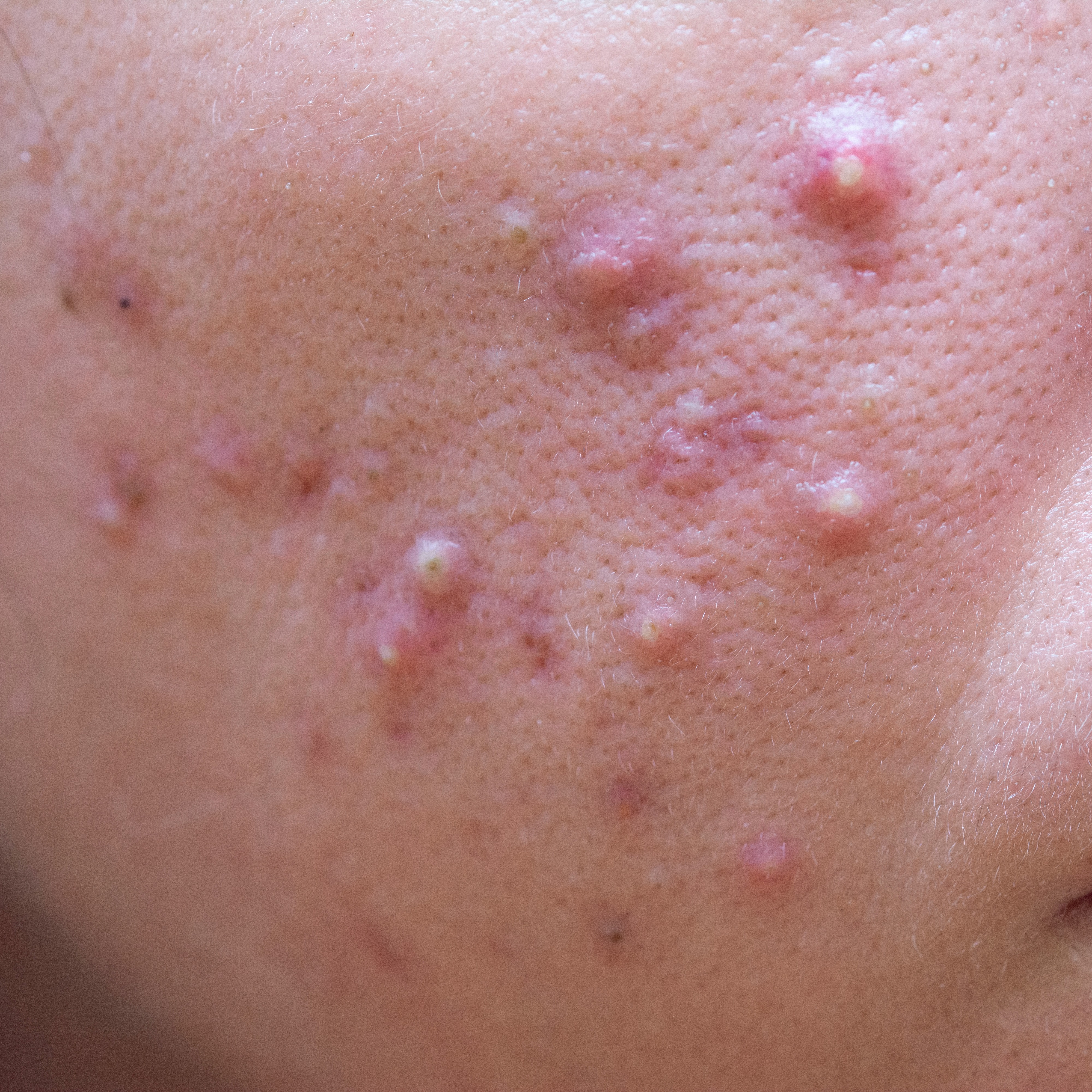 Acne vulgar; hormonal; fúngica; cosmética. thumbnail