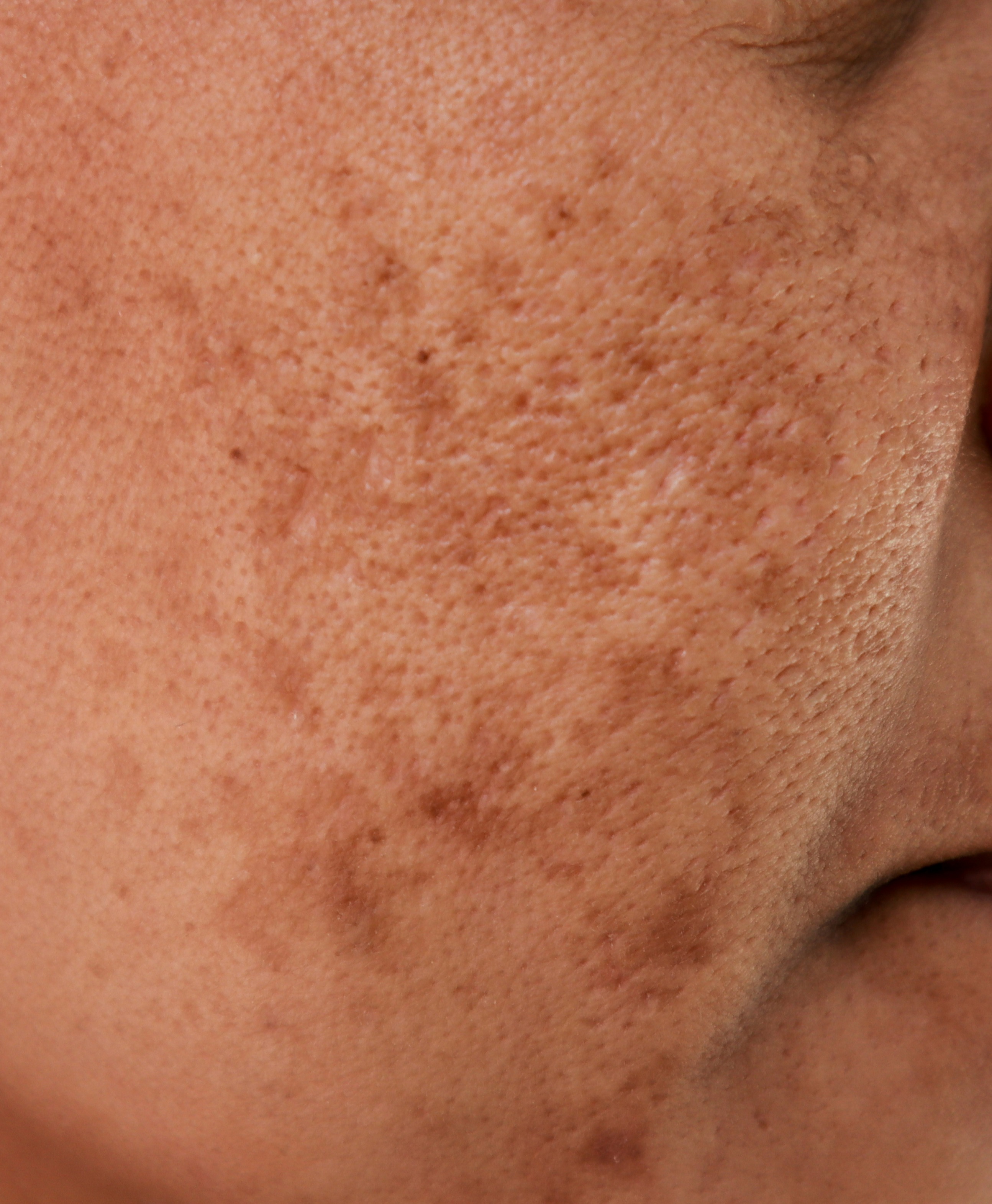 Melasma thumbnail