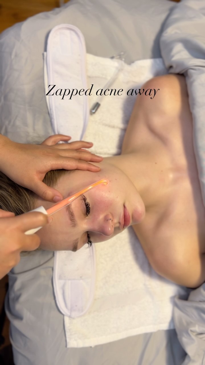 Zapped ⚡️ acne away with me